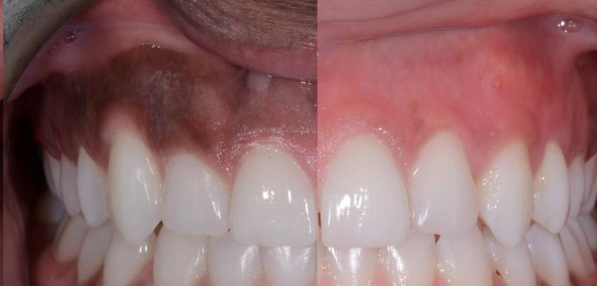 LASERS IN GUM TREATMENT